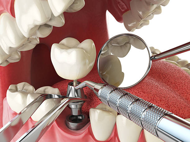 Best Emergency Tooth Extraction in Balmville, NY