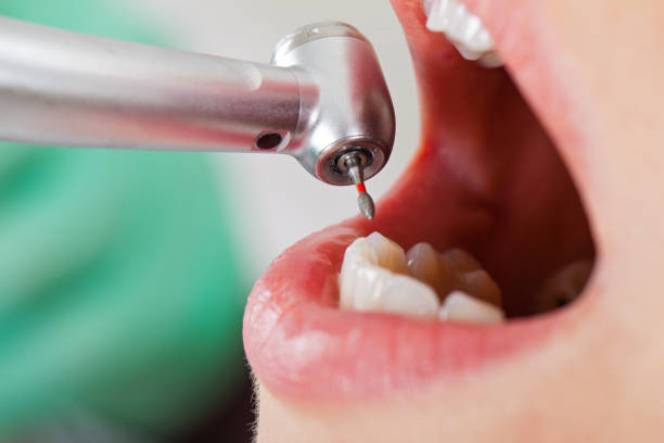 Best Emergency Wisdom Teeth Removal in Balmville, NY